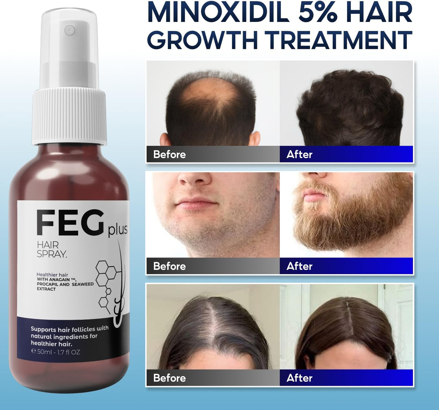 FEGPLUS Minoxidil Hair & Beard Growth Serum (50ml), Seaweed & Rosemary Extract Water, Minoxidil 5% Hair Growth Treatment